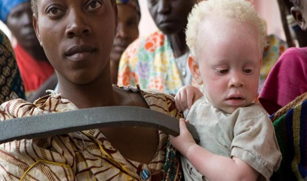 Albinism: UN official welcomes latest developments in &lsquo;landmark&rsquo; Malawi murder case