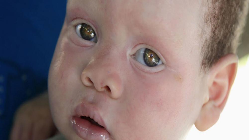 &lsquo;End the ongoing atrocities&rsquo; against people with albinism in Malawi, say UN rights experts