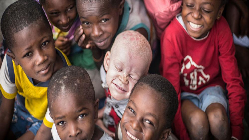 Recognize, celebrate and &lsquo;stand in solidarity&rsquo; with persons with albinism