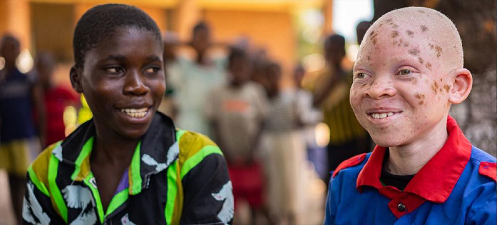 &lsquo;Inclusion is strength&rsquo; stresses UN, marking Albinism Awareness Day
