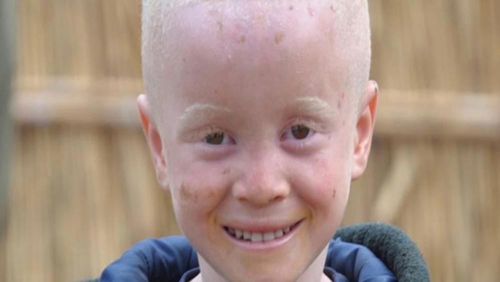 Kenya makes progress in supporting people with albinism, but &lsquo;much remains to be done&rsquo; says UN expert